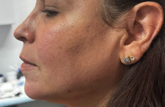 jawline sculpting after